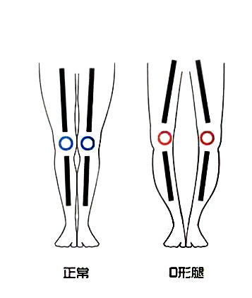 O型腿