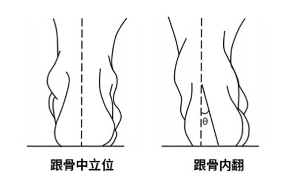 跟骨内翻